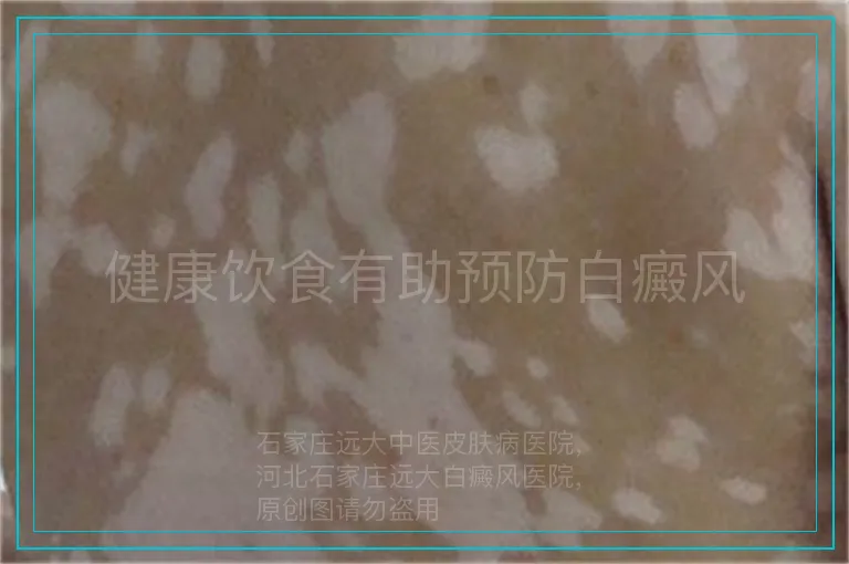 健康饮食有助预防白癜风