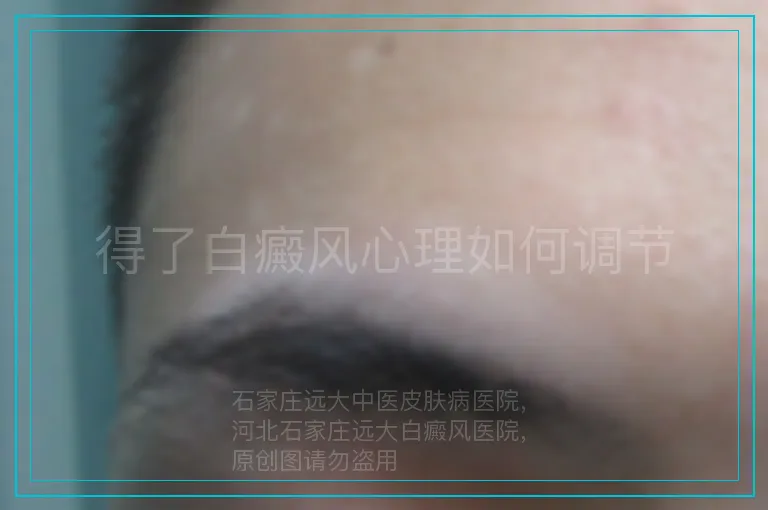 得了白癜风心理如何调节