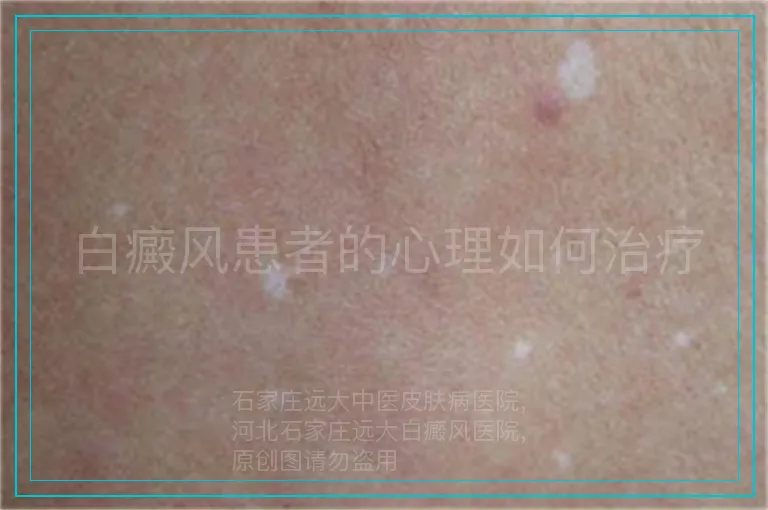 白癜风患者的心理如何治疗