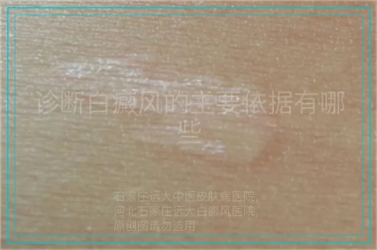 诊断白癜风的主要依据有哪些