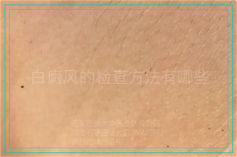 白癜风的检查方法有哪些
