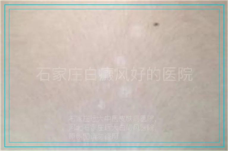 石家庄白癜风好的医院
