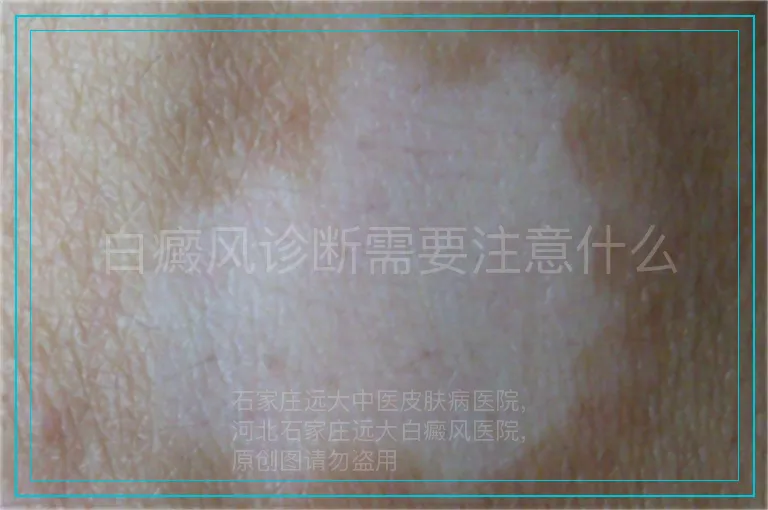 白癜风诊断需要注意什么