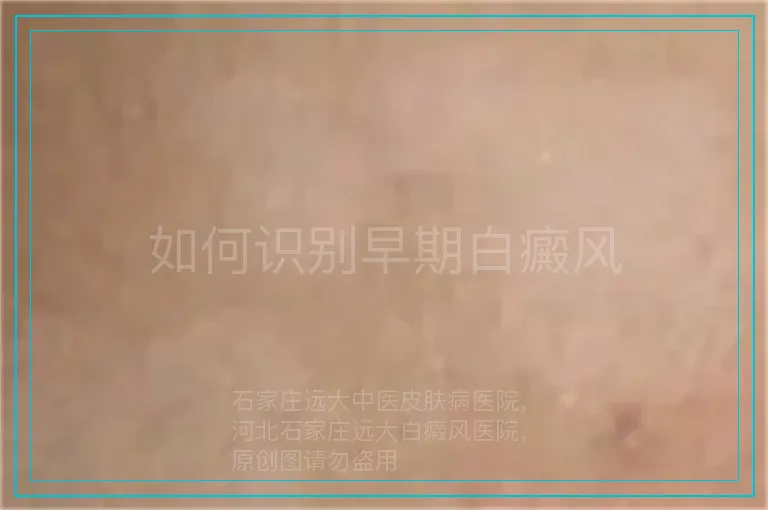 如何识别早期白癜风