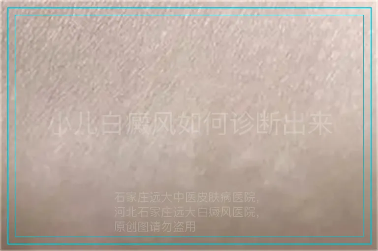 小儿白癜风如何诊断出来
