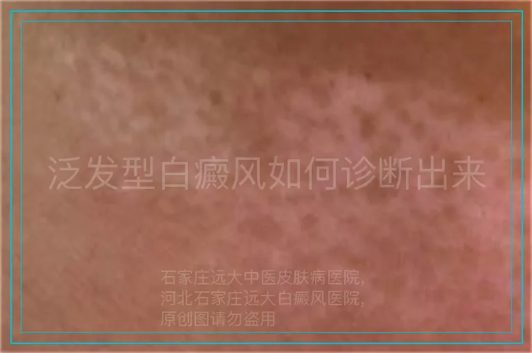 泛发型白癜风如何诊断出来