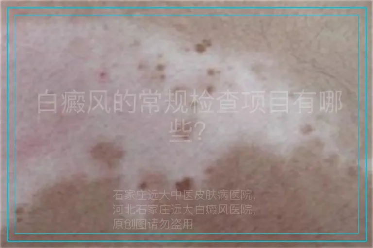 白癜风的常规检查项目有哪些？