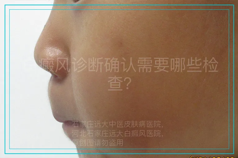 白癜风诊断确认需要哪些检查？
