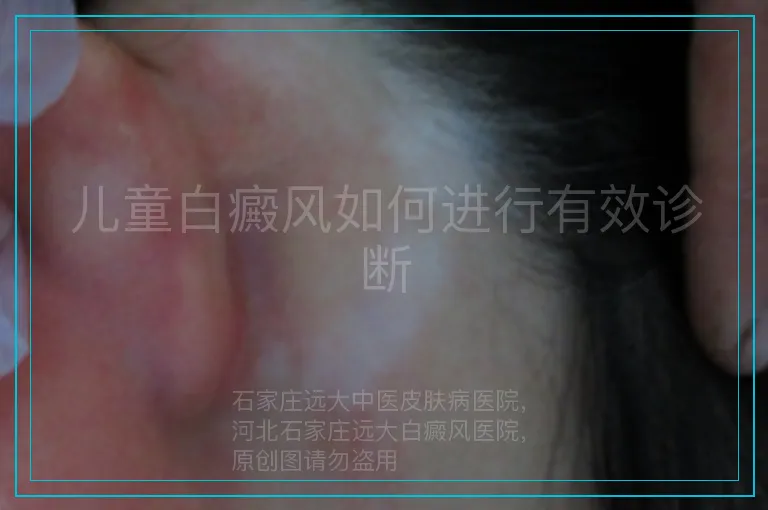 儿童白癜风如何进行有效诊断