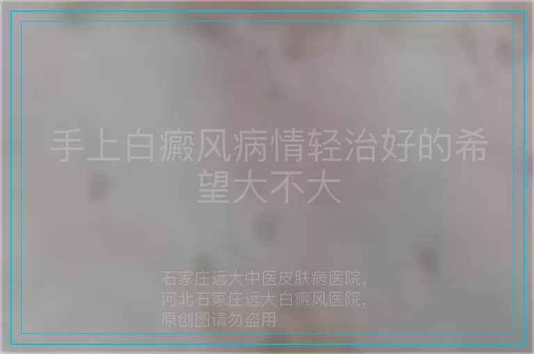 手上白癜风病情轻治好的希望大不大