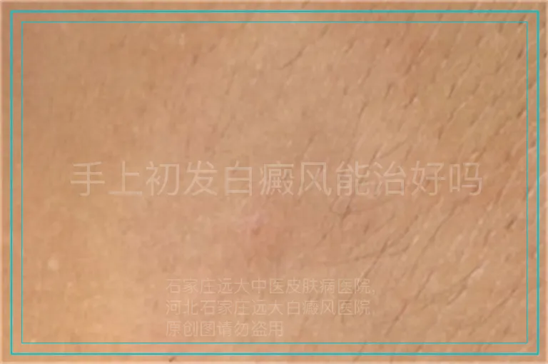 手上初发白癜风能治好吗