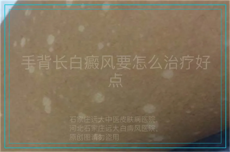 手背长白癜风要怎么治疗好点
