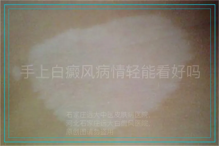 手上白癜风病情轻能看好吗