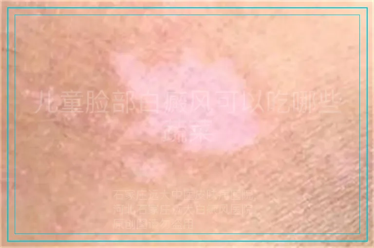 儿童脸部白癜风可以吃哪些蔬菜