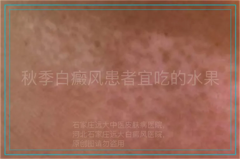秋季白癜风患者宜吃的水果