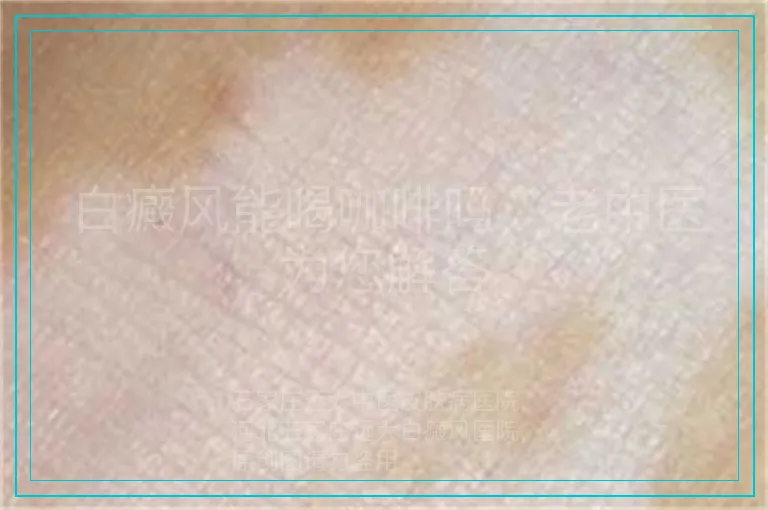 白癜风能喝咖啡吗，老中医为您解答