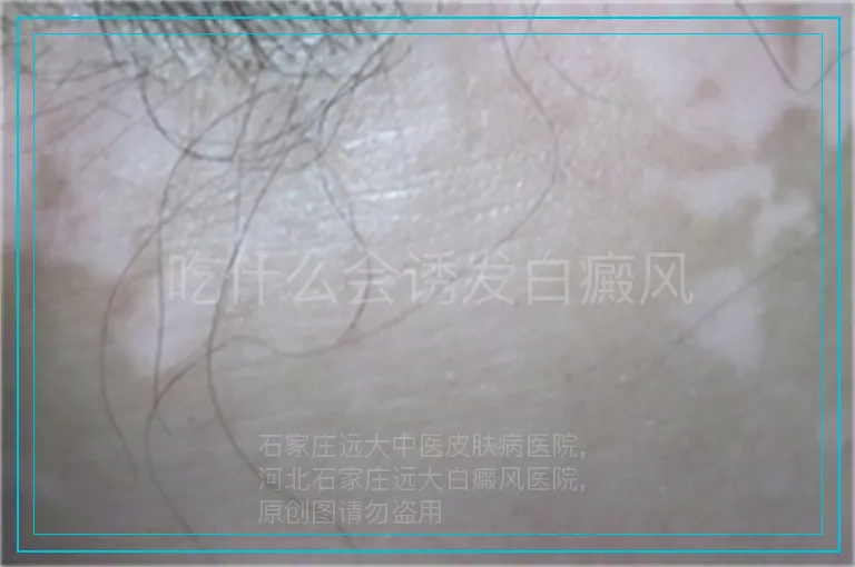 吃什么会诱发白癜风