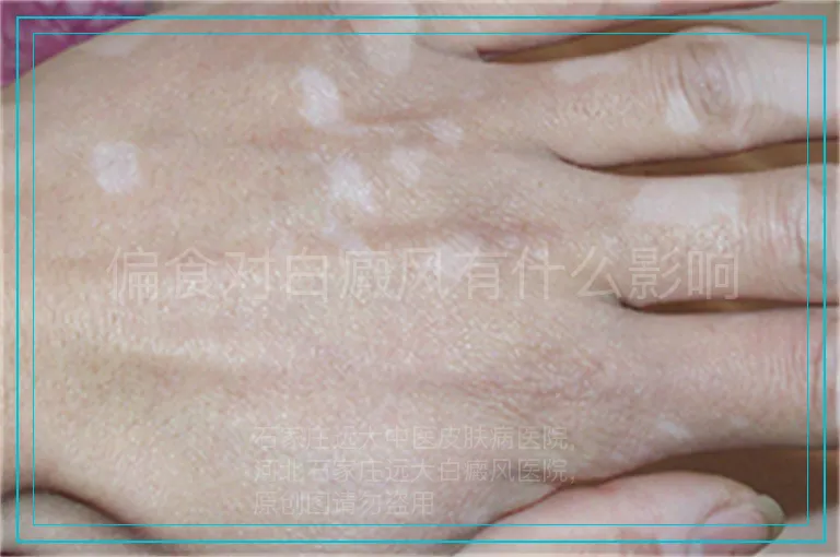 偏食对白癜风有什么影响