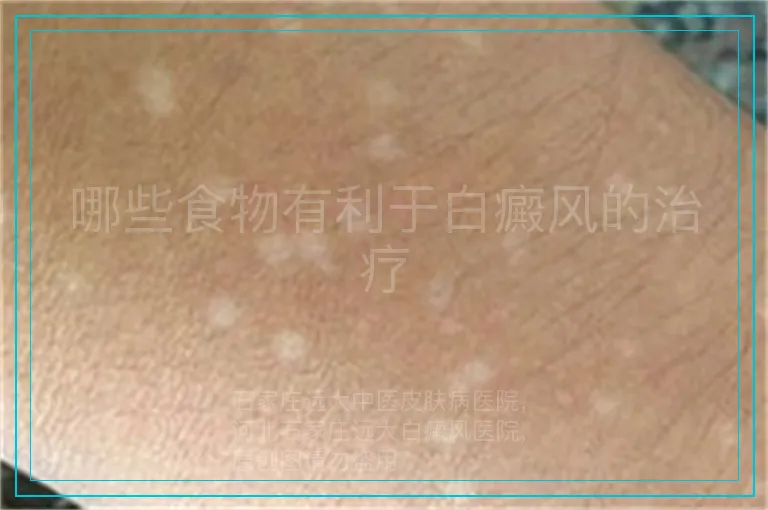 哪些食物有利于白癜风的治疗