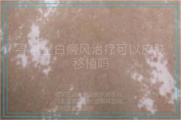 寻常型白癜风治疗可以皮肤移植吗