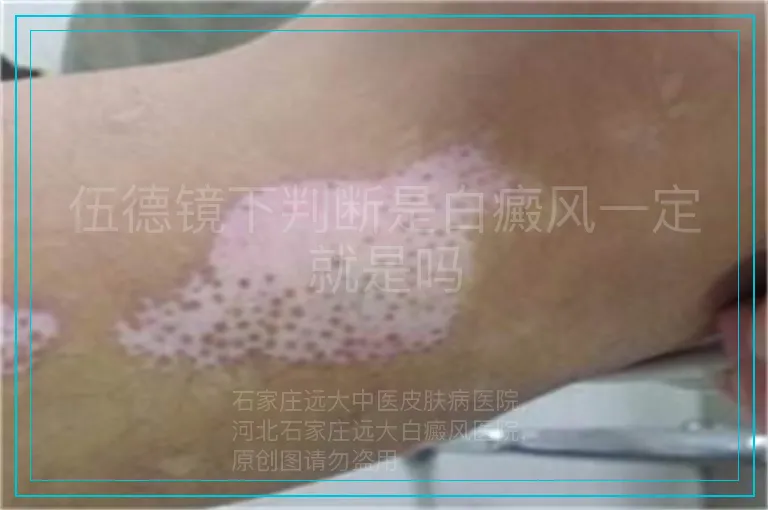 伍德镜下判断是白癜风一定就是吗