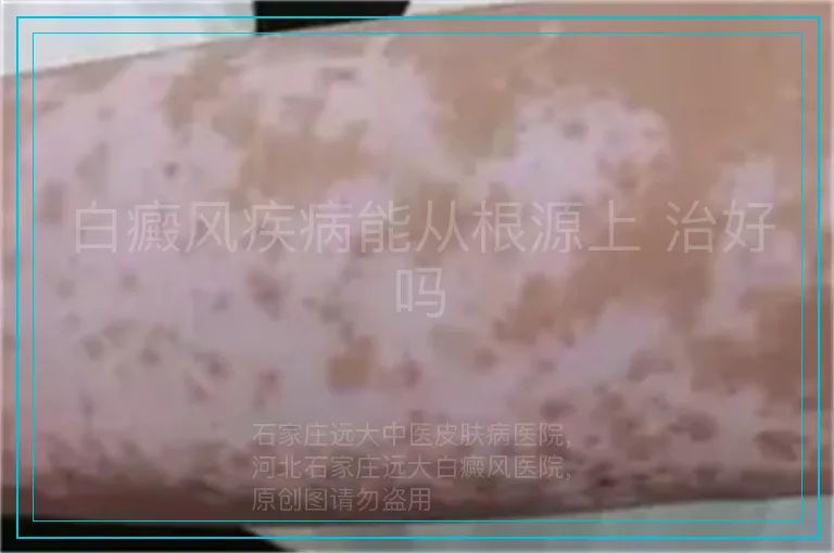 白癜风疾病能从根源上 治好吗