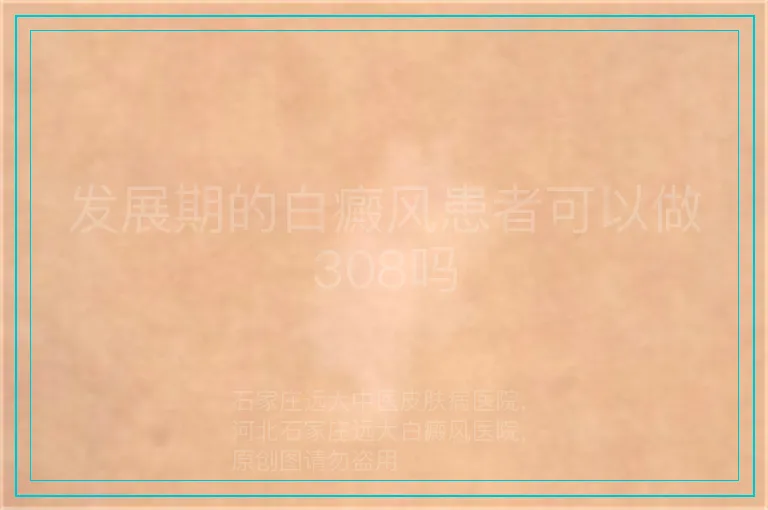 发展期的白癜风患者可以做308吗