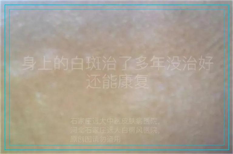 身上的白斑治了多年没治好还能康复