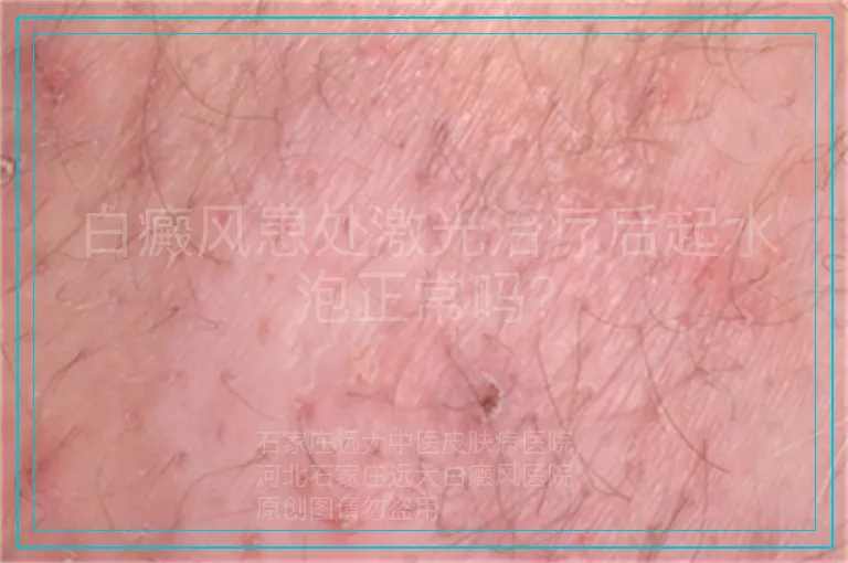白癜风患处激光治疗后起水泡正常吗?