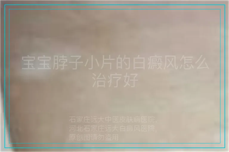 宝宝脖子小片的白癜风怎么治疗好