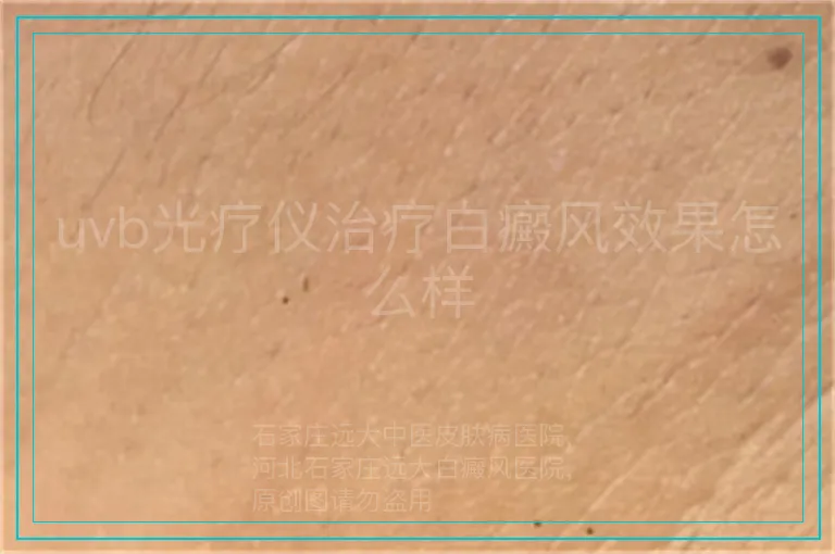 uvb光疗仪治疗白癜风效果怎么样