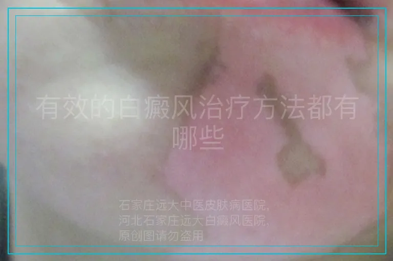 有效的白癜风治疗方法都有哪些