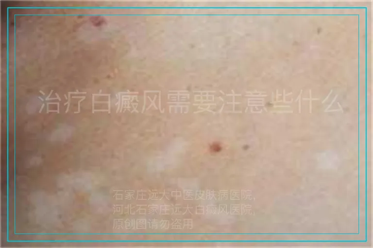 治疗白癜风需要注意些什么