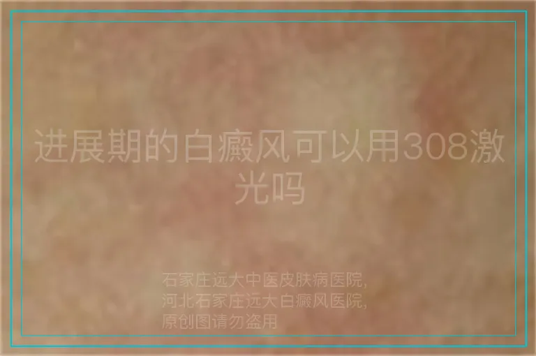 进展期的白癜风可以用308激光吗