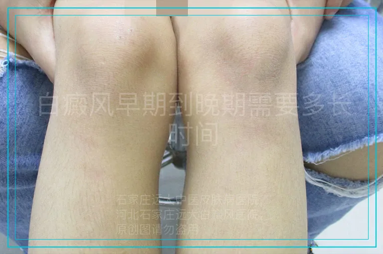 白癜风早期到晚期需要多长时间