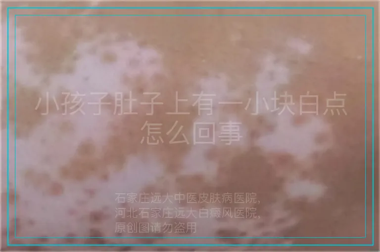 小孩子肚子上有一小块白点怎么回事