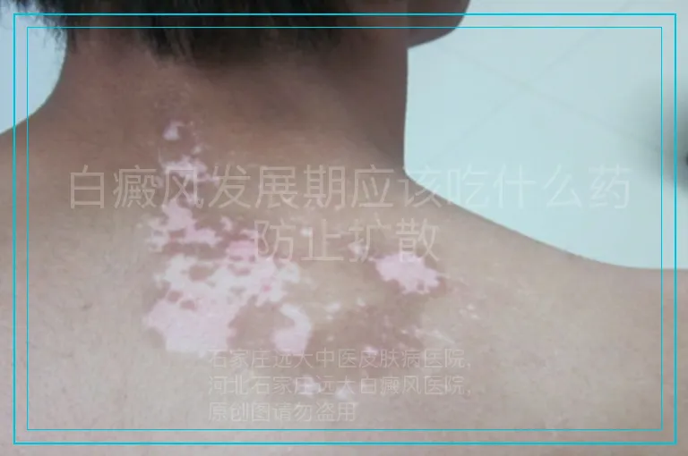 白癜风发展期应该吃什么药防止扩散