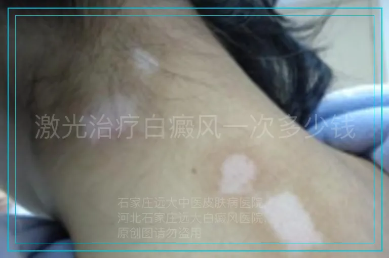 激光治疗白癜风一次多少钱