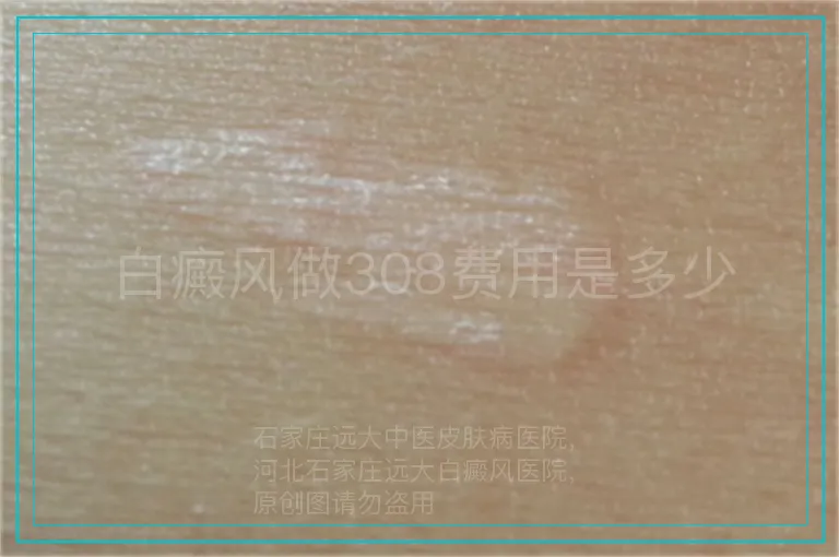 白癜风做308费用是多少