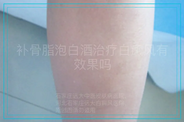 补骨脂泡白酒治疗白癜风有效果吗