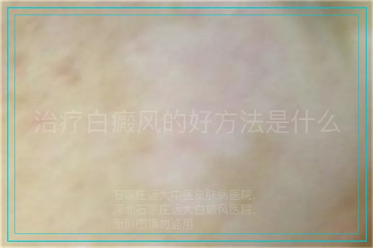 治疗白癜风的好方法是什么