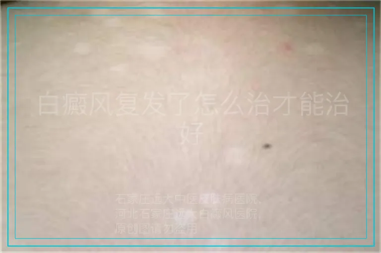 白癜风复发了怎么治才能治好