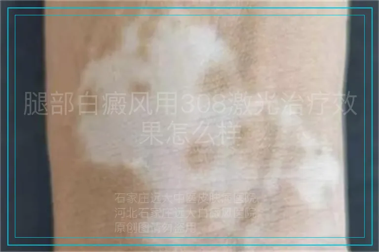 腿部白癜风用308激光治疗效果怎么样