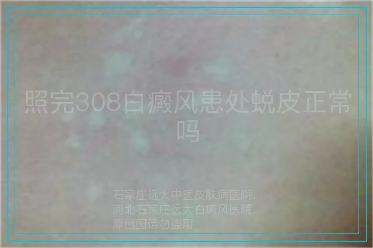 照完308白癜风患处蜕皮正常吗