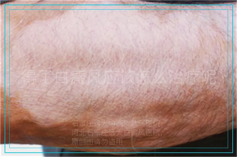 得了白癜风应该怎么治疗呢