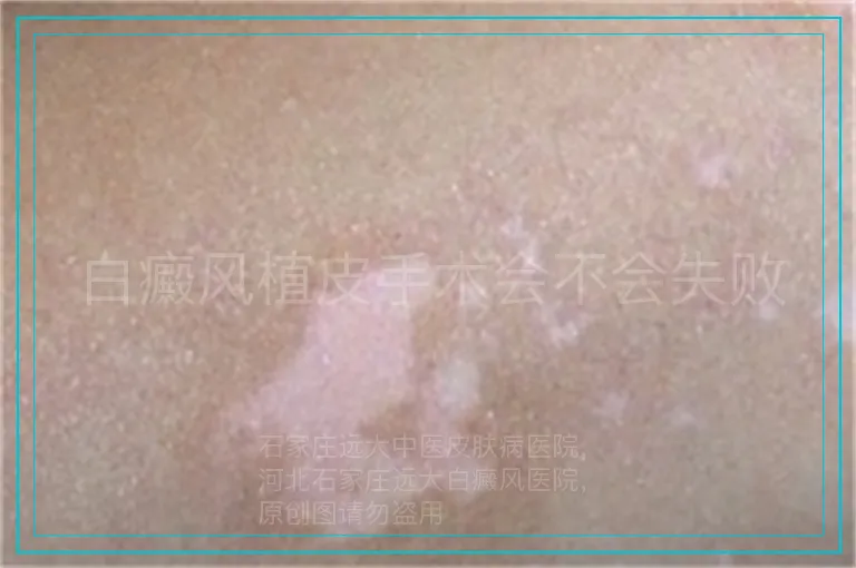 白癜风植皮手术会不会失败