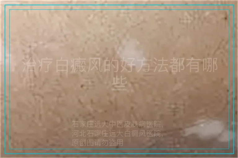 治疗白癜风的好方法都有哪些