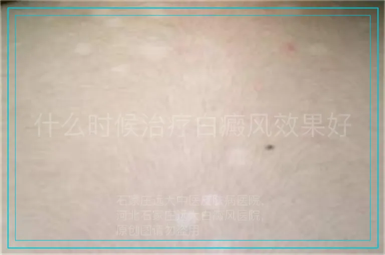 什么时候治疗白癜风效果好