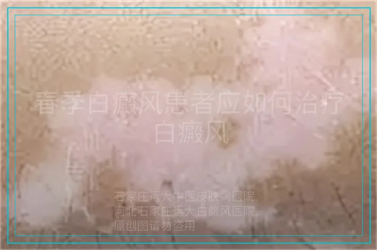 春季白癜风患者应如何治疗白癜风