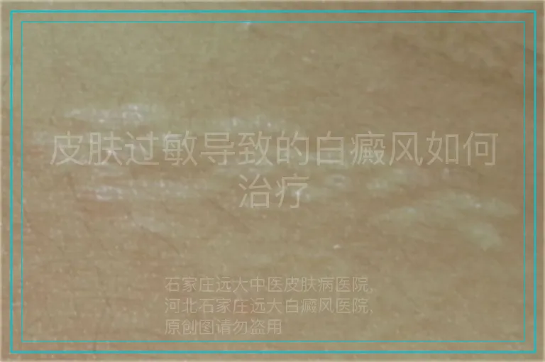 皮肤过敏导致的白癜风如何治疗